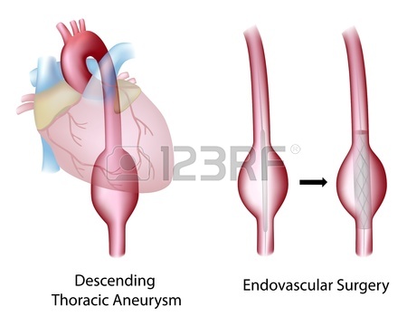 Endovascular Repair Of Abdominal Aortic Aneurysm Radiology