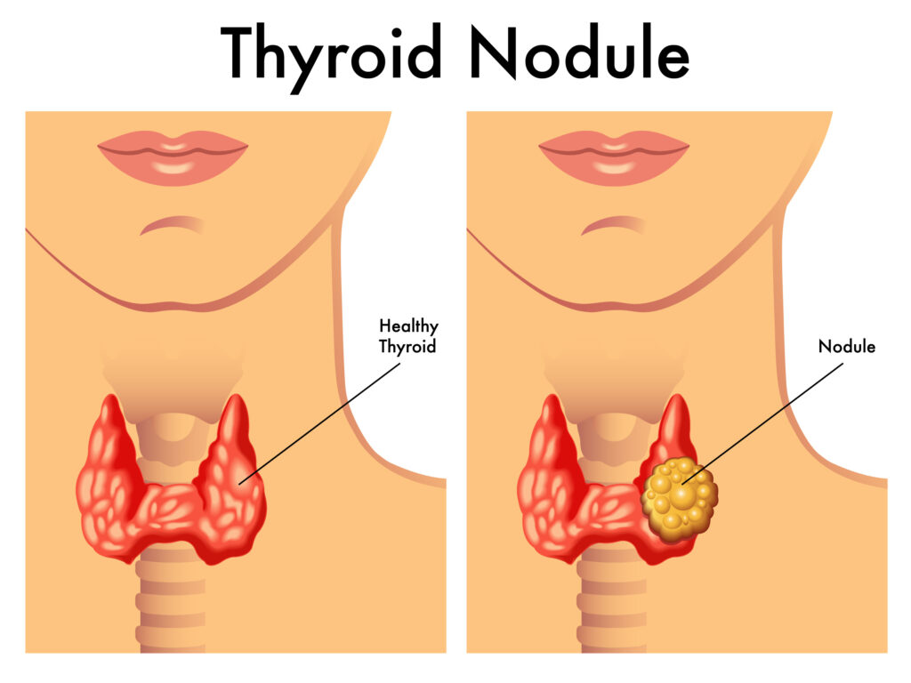 Health thyroid vs. thyroid with nodule