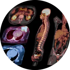 Molecular Radiology Pet Ct Fusion3