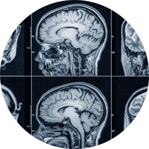 Imágenes de neurorradiología