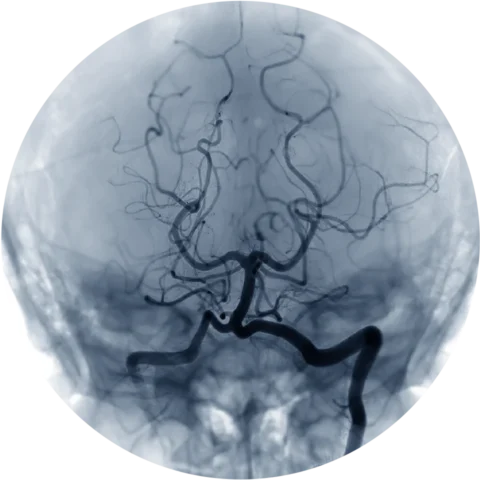 Vascular Interventional Image