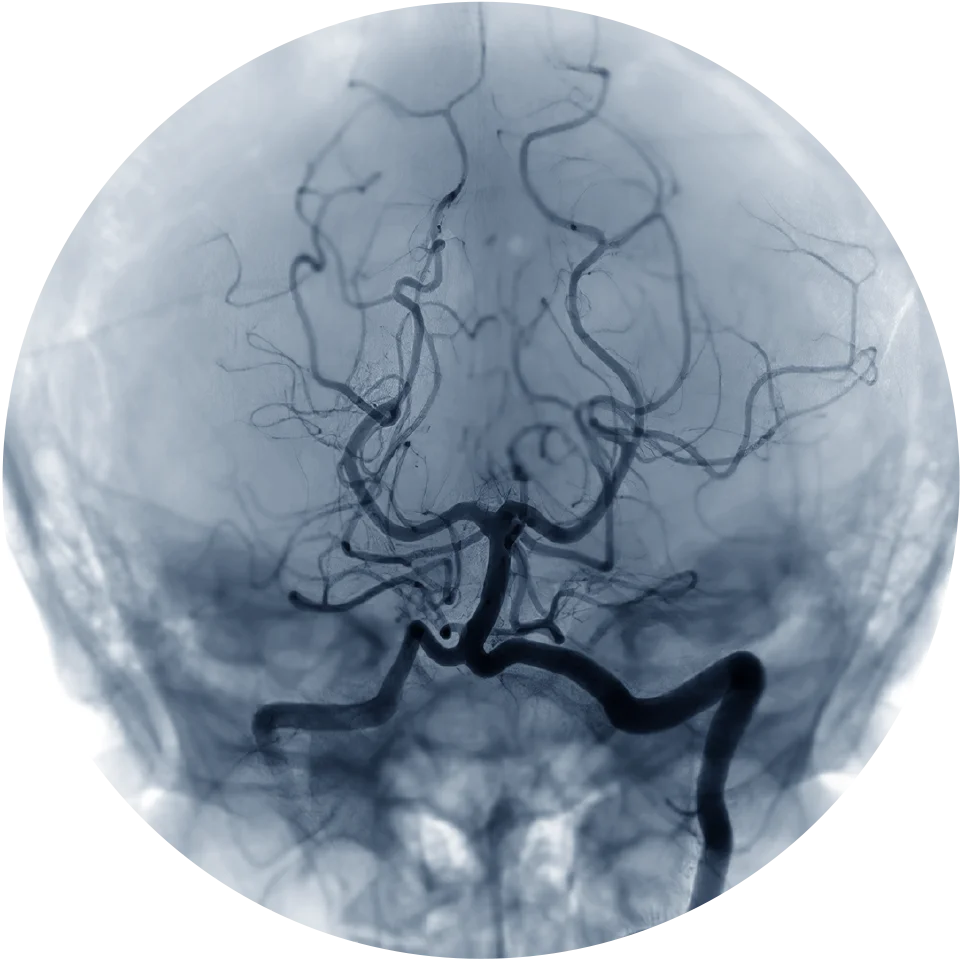 Vascular Interventional Image