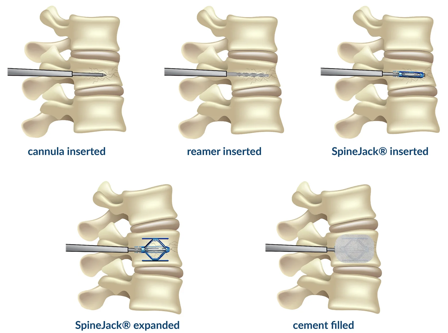 Ilustración de Jack de columna vertebral